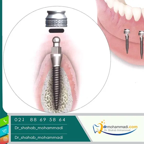 راهنمای جامع قیمت مینی ایمپلنت دندان
